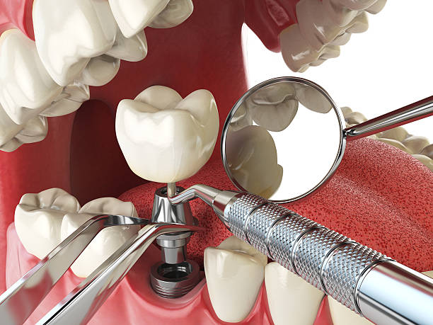 Best Emergency Denture Repair in Cumberland, MD